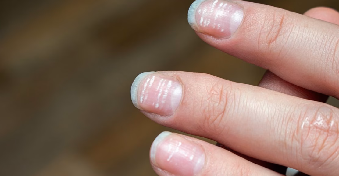 Mycose des ongles : causes, symptômes et traitements